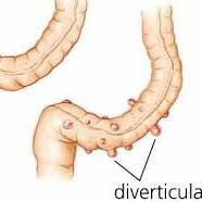 Diverticulitis Cure (@diverticulacure) 's Twitter Profile