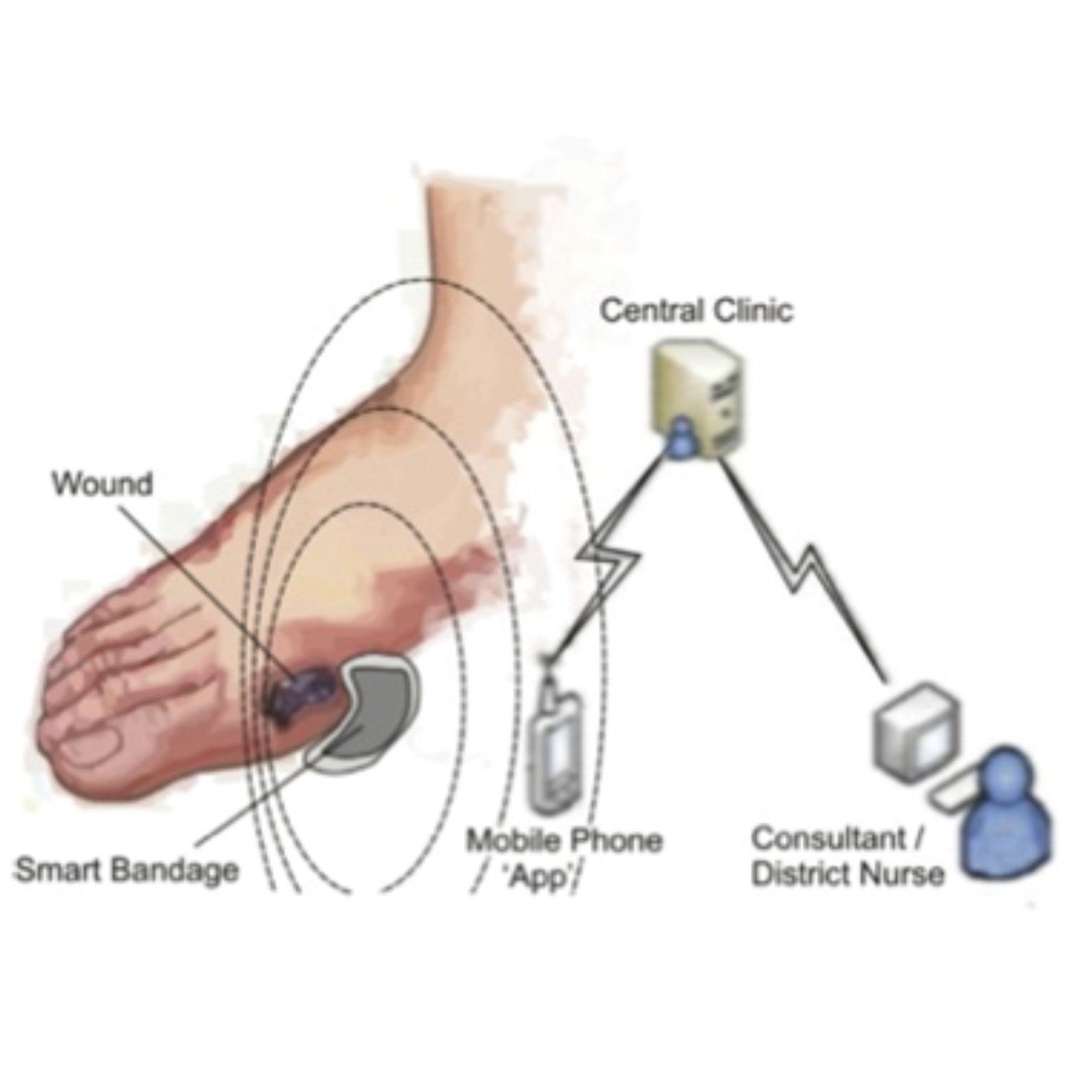 #Research into the development of: #SmartBandages for #chronicwounds - #DiabeticFootUlcers & #Ostomy management