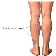 Detailed explanation of varicose veins and natural healing methods.