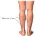 Varicose Veins Fix (@VaricoseVeinFix) Twitter profile photo