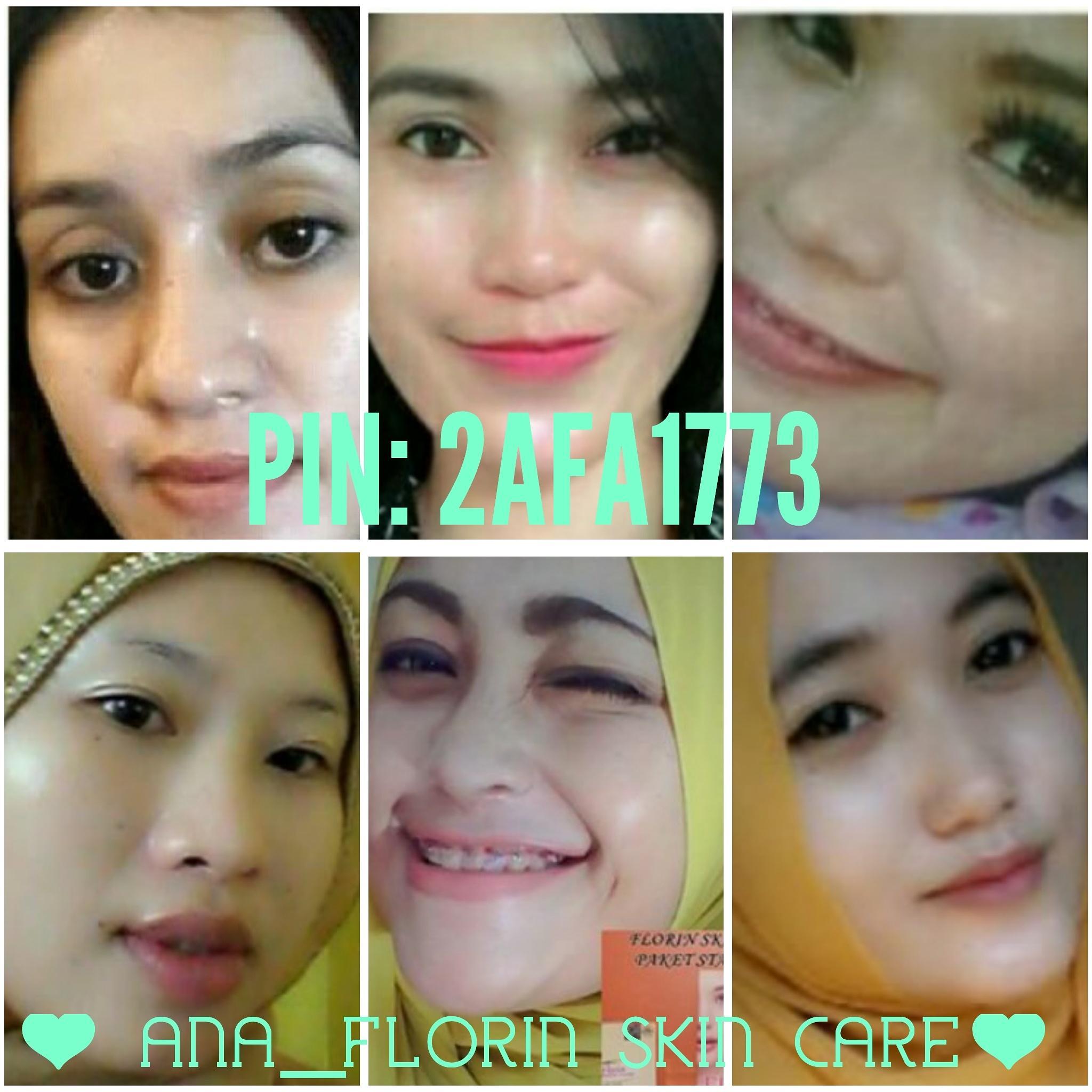 Cantik dan Ganteng itu butuh proses, jadilah salah satu saksi dari proses peremajaan kulit ini. :) ***FLORIN SKIN CARE***