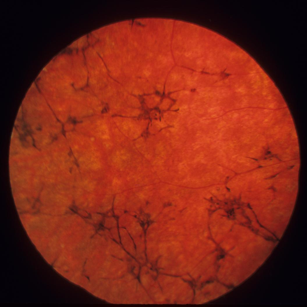 UsherSyndromeUK's profile picture. #UshersSyndrome #RetinitisPigmentosa #RP #Join #Follow