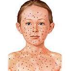 Increasing awareness and spreading knowledge of Chicken Pox in young adults since 2015!!