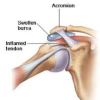 Shoulder Pain Fix(@ShoulderPainFix) 's Twitter Profile Photo