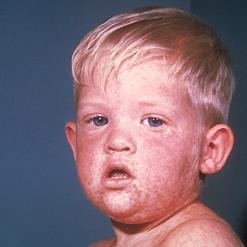 Here to inform you and stop the spreading of measles #vaxyourkids