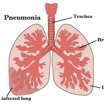 Twitter account for moms with young children giving information, tips, and advice in order to stop the spread of pnuemonia.