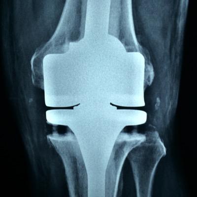 Alta Especialidad Quirúrgica en Prótesis de cadera y de rodilla. Nos ubicamos en la Ciudad de México, área metropolitana y Querétaro.