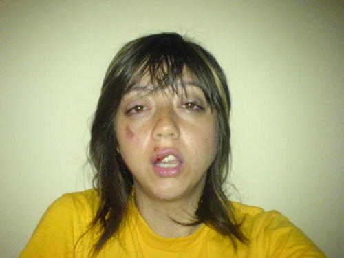 smashed my face in bicycle accident and blogging my way out of medical bills! (and other money tips!)