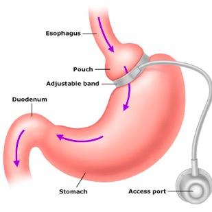 Giving information with regards to gastric, lap-band lifestyle. Had mine fitted November 2014. Best thing I every did and now wish to share with everyone