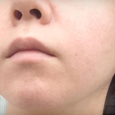 美肌夢子 على تويتر 毛穴の角栓 モサ について 根本的に角栓を治す方法 肌断食 角質培養 はじめました Http T Co N6zz9tid3r