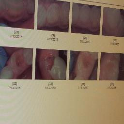 this twitter page to help save my heart.My teeth are causing my heart disease:( My heart is most important! but IhaveMANEY health problems:( MY STORY BELOW:)URL