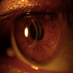 Keratoconus (@keratocornea) Twitter profile photo Keratoconus (@keratocornea) Twitter profile photo