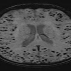 International platform for updates on Cerebral Microbleeds 🧠🩸– an MRI marker of cerebral small vessel disease. #microbleeds 👨‍💻