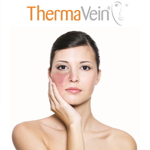 ThermaVein® the safe, instant and effective alternative to laser, IPL or electrolysis for the treatment of Red Veins, Threadveins and vascular blemishes