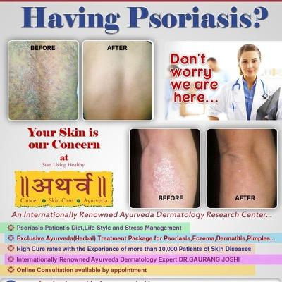 #International #Ayurveda #Dermatology Physician,Expert for #Psoriasis and #Vitiligo
