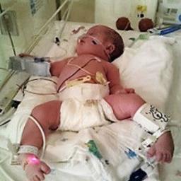 Jason Scott Miller was born on October 8, 2015,.  After birth, Jason was diagnosed with Down Syndrome, Bi-lateral clubfoot, and the heart defect complete AVSD