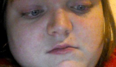 I have McCune Albright's syndrome and I have athlete's foot to (stupid feet)