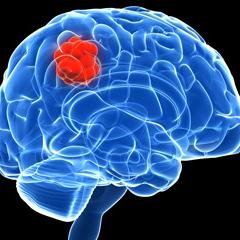 Follow for the latest updates on Brain tumors. This is a bot tweeting about brain tumors associated to iMM Lisboa and Faculdade de Medicina de Lisboa