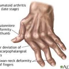 Get rheumatoid arthritis treatment and care information. The self help that you need.