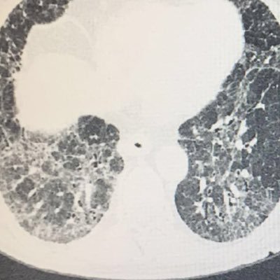 Interstitial Lung Disease and Rheumatology Unit. Instituto Nacional de Enfermedades Respiratorias, Ismael Cosio Villegas