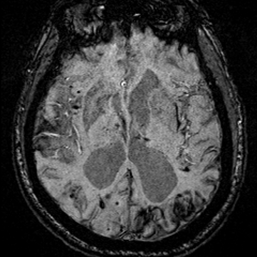 @BrainBleeds is aimed to increase public awareness of #Intracerebral #Hemorrhage. @BrainBleeds is NOT intended to give clinical advice to ANY individual.