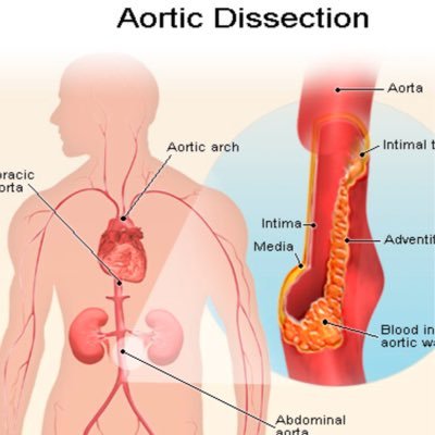 Promoting #AorticDissectionAwareness, Education & Support throughout U.S. & the world! Tweets do not constitute Medical Advice. #aorticdissection #aorta #aortic