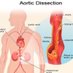 @AorticDissectUS