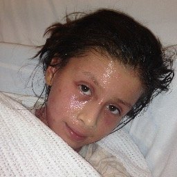 Hi my name is Nayeli Gajardo and I am sick from very bad eczema - Please read my story