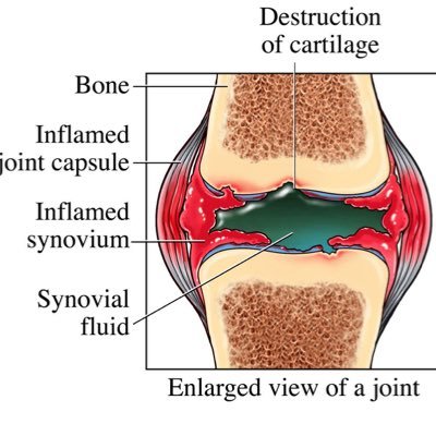 Anyone can get RA, though it occurs more often in women. RA often starts in middle age and is most common in older people. #HealTheJoints