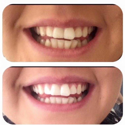 Affordable cosmetic teeth whitening - we have studios in Aylesbury/ Barnet/ Beaconsfield/ Berkhamsted/ Brighton/ Warwick just £95 DM us to book