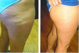 The Best Treatment of Cellulite