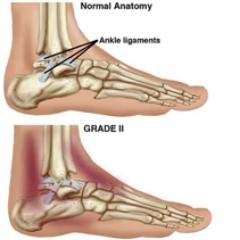 Everything you need to know about ankle sprains