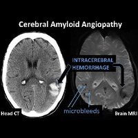 Amyloid Angiopathy(@CAA_Disease) 's Twitter Profile Photo