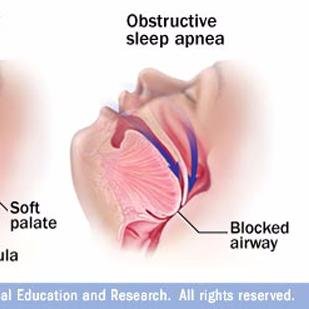 TMJDoctor's profile picture. Treating TMJ and Sleep Apnea Patients with oral appliances. Hate CPAP???? I can help!