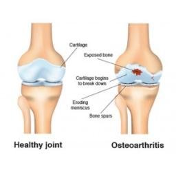 Unistem Biosciences offer stem cell treatment in india for osteoarthritis of knee joint, hip, shoulder, ankle and spine.