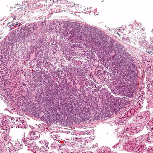 A Twitter Handle for NIFTP-the non-invasive follicular thyroid neoplasm with papillary like nuclei