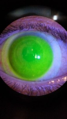 NikolausGolser's profile picture. SCLERAL LENS CENTER - CENTRO LENTI SCLERALI - Costruzione e applicazione lenti sclerali e lenti a contatto artigianali su misura. 

nikolausgolser.it