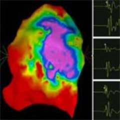 The most recent knowledge and expertise in the management of patients with Brugada syndrome, using epicardial right ventricular RF ablation.