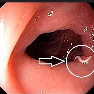 Giardia verme sintomas