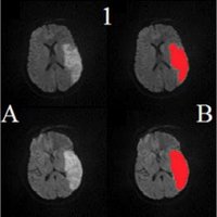 Atrial Fibrillation (@afib_disease) 's Twitter Profile