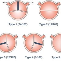 Bicuspid Aortic Valve(@bicuspidaortic) 's Twitter Profile Photo