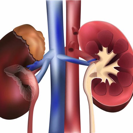 Descubriendo la Insuficiencia Renal.