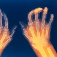 Clinical Rheumatology pearls for Rheumatologists, physicians, Internists, family practice, primary care, residents, fellows and patients.