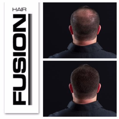 Hair Fusion is a cosmetic product made from 100% real human hair that allows men and women to conceal the appearance of thinning hair and bald spots.