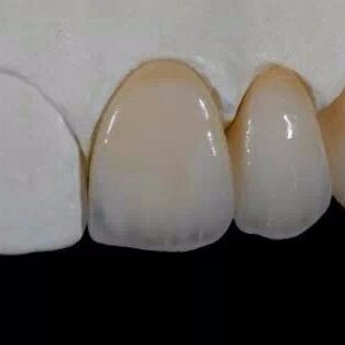 China HongKong,Zirconias  PFM  E-Max Implant sopport, ,Dentures,FRAMEWORKS,Mouth Guards