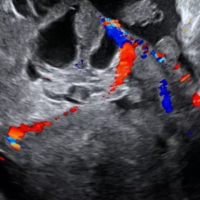 Tweets by Dr Susanne Johnson FRCOG, main interest Gynaecology Ultrasound, esp Endometriosis https://t.co/8SD4rYgdQP