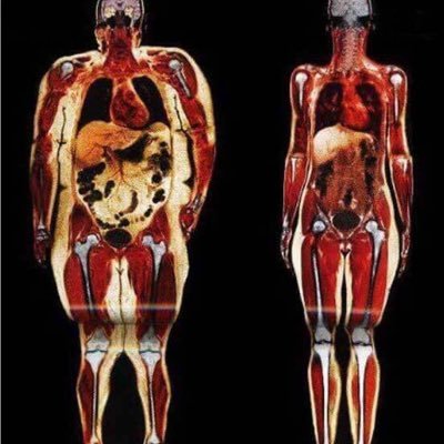 Medical student detailing his own metabolic syndrome reversal. Join me on my journey.