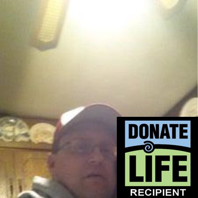 heart transplant recipient. stroke survivor. post transplant diabetic syndrome.