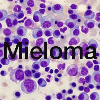 Neoplasia de células plasmáticas caracterizada por una proliferación clonal de células plasmáticas malignas en el microambiente de la médula ósea.