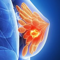 Breast Cancer News (@breastcanews) 's Twitter Profile